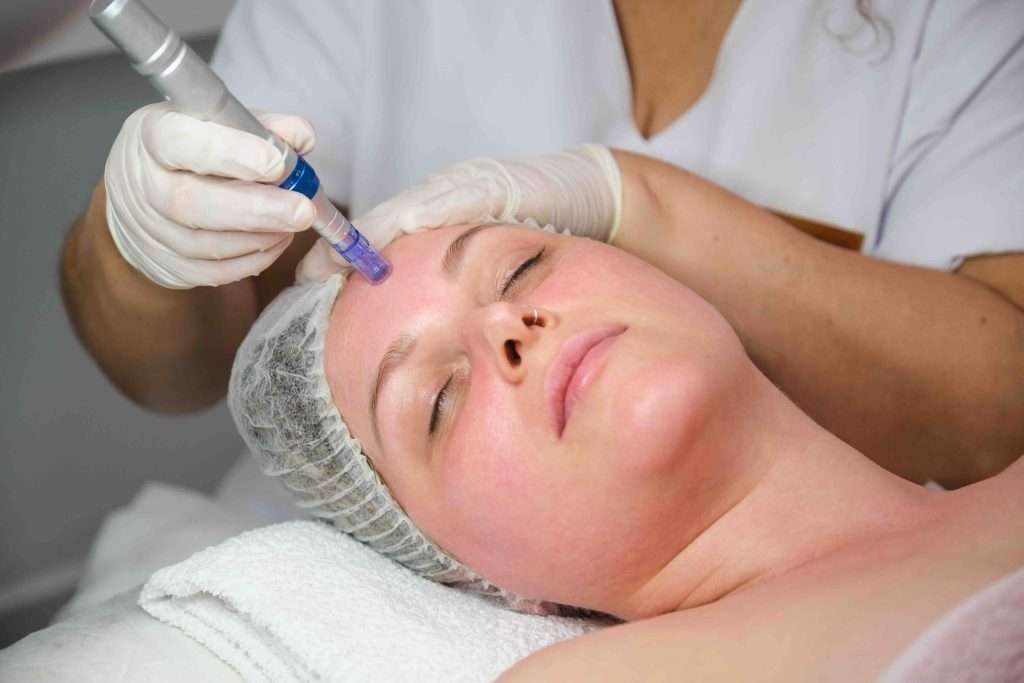 Dermapen Facial